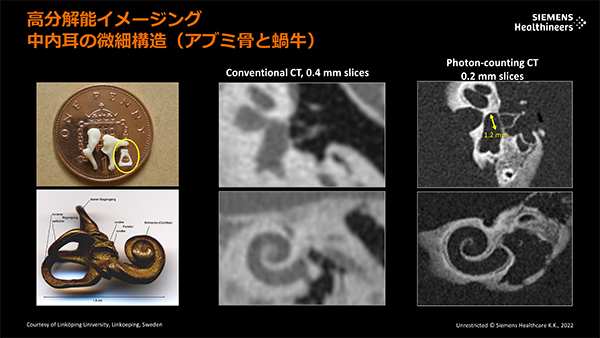 NAEOTOM Alphaではアブミ骨や蝸牛も明瞭に描出