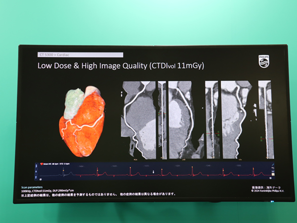 低線量でブレのない心臓CT検査を実現