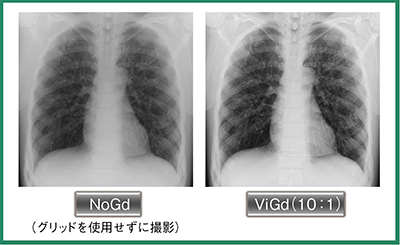 図2　グリッドなし（左）とVirtual Grid（右）による胸部ファントム画像の比較