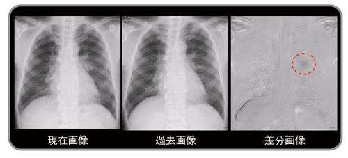 図6　有用症例：左肺門部に重なる陰影（扁平上皮癌）