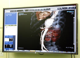 手術室内には術前のCT画像などを表示する大画面モニタを設置