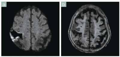 症例5　頭部の拡散強調画像 （陳旧性の脳梗塞の近くに新たな脳梗塞が生じた症例）