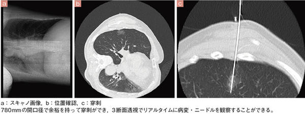 症例1 CT透視（側臥位）