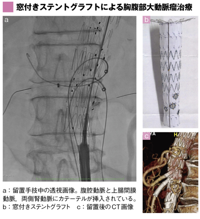 窓付きステントグラフトによる胸腹部大動脈瘤治療