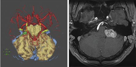 左頭蓋窩髄膜腫症例の術前シミュレーション画像