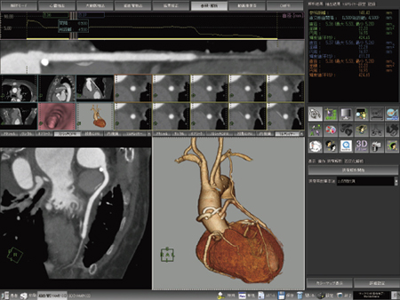 CABG後の冠動脈解析処理画像