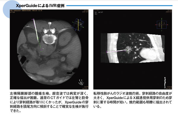 XperGuideによるIVR症例