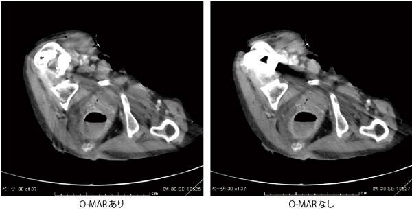 O-MAR（Metal Artifact Reduction for Orthopedic Implant）による画像比較