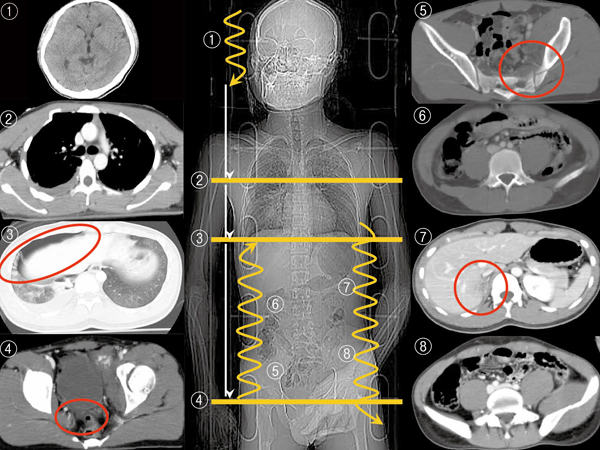 症例1 外傷パンスキャンと読影の実際（Focused Assessment with CT for Trauma：FACT）