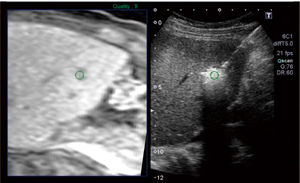 【Smart Fusion使用例】MRI-EOBの肝細胞相にてdefectとなっている1cm以下のclassical HCCをFusion Imageで検索し，Target Point機能でHCCを囲むようにマーク（緑の丸）を設定した。その後，US上でマークを参考にしながら結節に穿刺した。画像は，焼灼直後のバブル発生の様子。MRI上の病変部位に対応している。