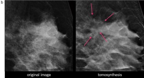b：‌左MLO拡大画像（左），トモシンセシス拡大画像（右）