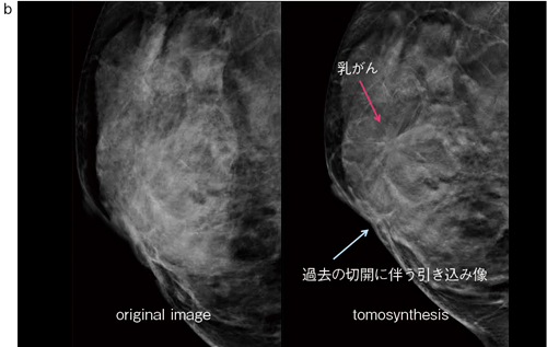 b：右MLO画像（左），トモシンセシス画像（右）