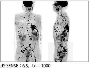症例1：多発性骨髄腫の“Direct Coronal DWI”（超高速DWIBS，2分40秒×3）