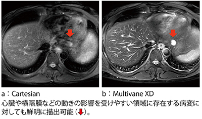 症例4：肝血管腫の“Multivane XD”（新しい体動補正機能）
