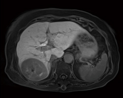 症例4：腹部造影MRI（StarVIBE/息止めなし）