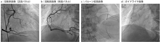 アンギオ臨床画像例：冠動脈インターベンションにおけるAlluraClarityの画像例
