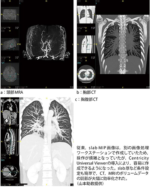 Centricity Universal Viewerで作成したslab MIP画像