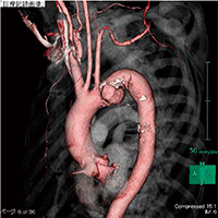 3DCT画像 ショートネック（腕頭動脈からの距離13mm）の弓部大動脈瘤に対しTEVAR施行の方針。