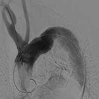 TEVAR術中画像(2) 左鎖骨下動脈は単純閉鎖。鮮明な画像でもエンドリークは確認できず安心して終了。