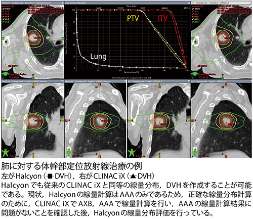 肺に対する体幹部定位放射線治療の例