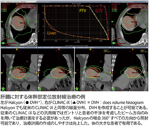 肝臓に対する体幹部定位放射線治療の例