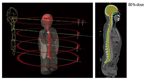 Halcyonによる全脳全脊髄照射の線量分布
