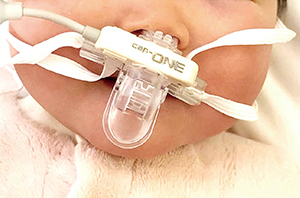 cap-ONEネイザルアダプタは小型・軽量で小児にも装着でき，メインストリーム方式で呼吸検出性能が高い。