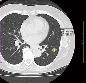 コンピュータ支援診断（CAD）で肺結節の候補を検出する。検出されたスライスにはスライダーバーにマークが表示され，医師がフォロー対象として指定した候補には計測結果を提示する。