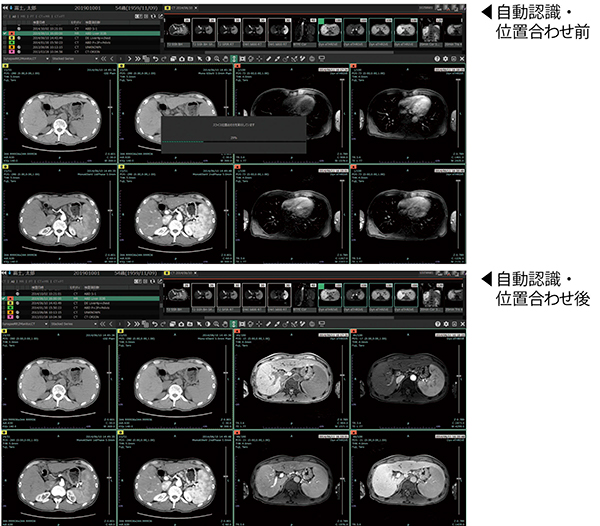 臓器セグメンテーション技術を生かした自動位置合わせ機能。同一モダリティだけではなく，CT，MRIなど異なるモダリティ間の位置合わせを行える。画面は肝臓の造影CT（左４シリーズ）を基準に，EOB-MRI（右４シリーズ）の位置合わせを行った例。
