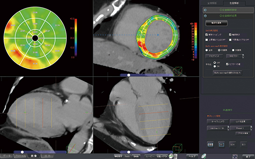 CT心筋ECV解析 心臓CTから細胞外容積分画（ECV）を算出してマッピングする。動きのある心臓の心筋を自動抽出し，複数の画像から数値を計算し画像に反映させるまで多くの計算能力を使って実現している。