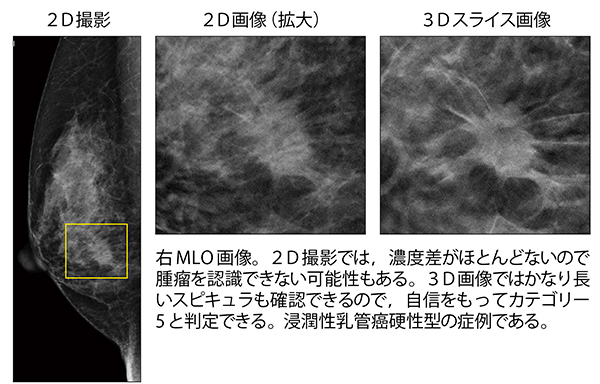 2D画像と3D画像の比較（浸潤性乳管癌硬性型）