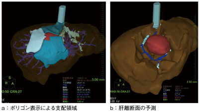 図3　“新・肝臓解析”を用いた術前シミュレーション