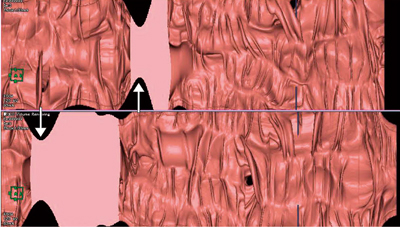 図1　展開像（opened image） 下行結腸の展開像。桃色は水没により不可視領域となっている領域を表している。同部にて腸管のくびれが認められ（↑），腸管径が狭小化していることが認識できる。