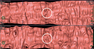 図2　展開像（opened image） 下行結腸の早期大腸がん（0-Ⅱa＋Ⅱc，12mm大）。半月ひだ上の結節状隆起として描出されている（○印）。両体位ともに同じ半月ひだ上に結節状隆起があるため，病変の可能性が高いと判断できる。この画像のみで表面の形態を判断するのは困難であるが，ほかの腸管粘膜面と比較して，同部が限局性に隆起していることが容易に検出可能である。