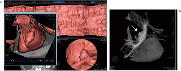 図3　キューブビュー（cube view） a：‌図2と同一症例。仮想内視鏡画像，展開像，キューブビューそれぞれでの描出のされ方の違いが興味深い。キューブビュー上では歪みのない表示が達成されている。 b：同病変のMIP画像。経静脈性造影剤投与後であり，腫瘍相当位置（→）の造影効果が反映されたMIP画像となっている。