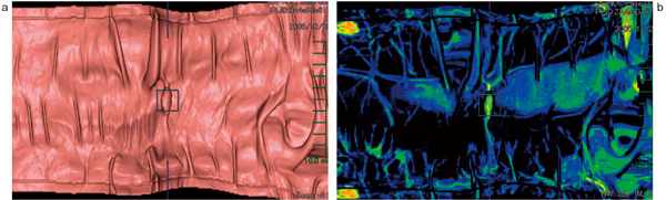 図4　展開像におけるMIP表示 a：図2と同一症例。 b：MIP表示。カラーリングを調整することで，腫瘍が色づいて見える。