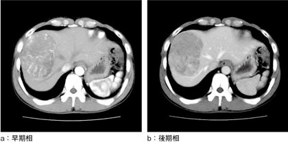 図1　術前CT 肝S8に径8cmの腫瘍を認める。早期相（a）で濃染し，後期相（b）では低吸収を呈して中肝静脈を越えてS4に張り出している。