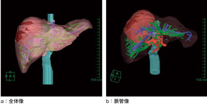 図2　3D画像 肝実質の透過性を調節することで，腫瘍の肝内での位置関係の把握が容易となる。肝動脈と門脈の関係も位置のズレがなく正確に表示できている。