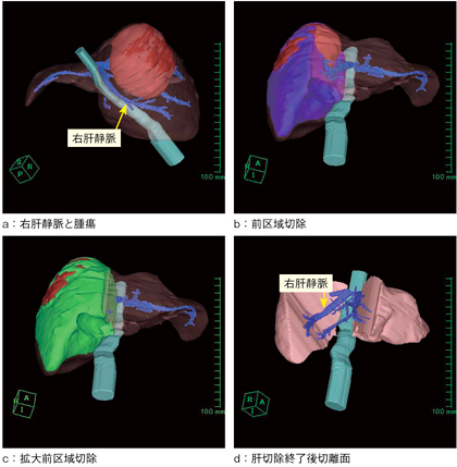 図3　術前シミュレーション 右肝静脈は腫瘍と離れておりintactであることがわかる（a）。前区域切除では腫瘍が切離面に露出する（b）ため，中肝静脈を切除する拡大前区域切除（c）の予定となった。dは切除後の肝切離面。