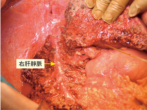 図4　術中写真 肝切除終了後の切離断面を示す。術前画像どおりに右肝静脈の末梢枝を認める。
