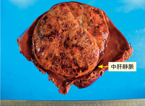 図5　切除標本割面 腫瘍が露出することなく切除できた。腫瘍に沿って中肝静脈が走行していることが確認できる。