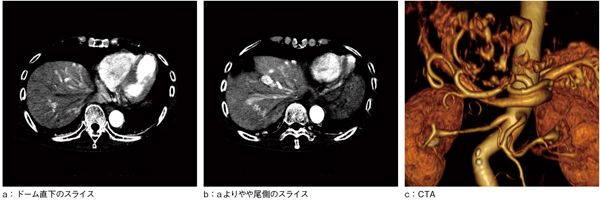 図1　血管塞栓術前の造影CT動脈相