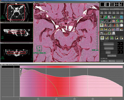 図1　神経血管Heavy T2強調画像を目的神経に絞ったVR画像とオパシティカーブ