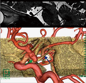 図2　症例1：Heavy T2強調のMPR再構成画像と脳神経Multi Volume画像の比較 →動脈瘤　→動眼神経