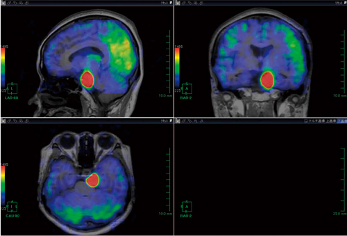 図1　頭部MRI 3D T1強調画像とperfusion imageのfusion画像：三叉神経鞘腫症例
