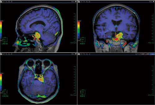 図2　頭部MRI 3D T1強調画像と造影画像のfusion画像（図1と同一症例）