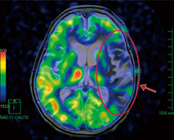 図3　頭部MRI T2強調画像とperfusion imageのfusion画像：脳梗塞症例←左MCA領域の血流低下