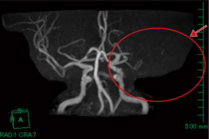 図4　頭部MRA：脳梗塞症例（図3と同一症例）←左MCAの描出不良