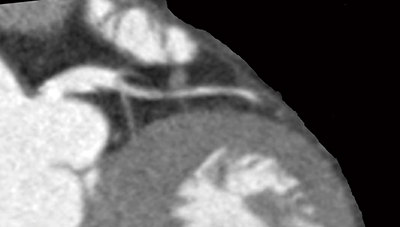 図1　心臓CTにおける冠動脈の解剖