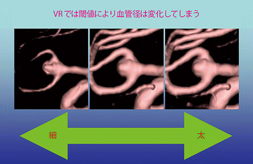 図1　VRにおける血管径の変化